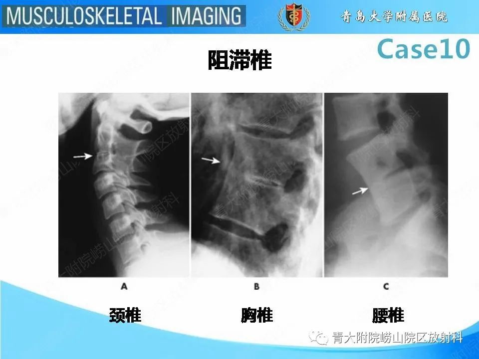 【PPT】后纵韧带骨化症