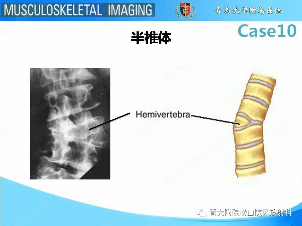 【PPT】后纵韧带骨化症