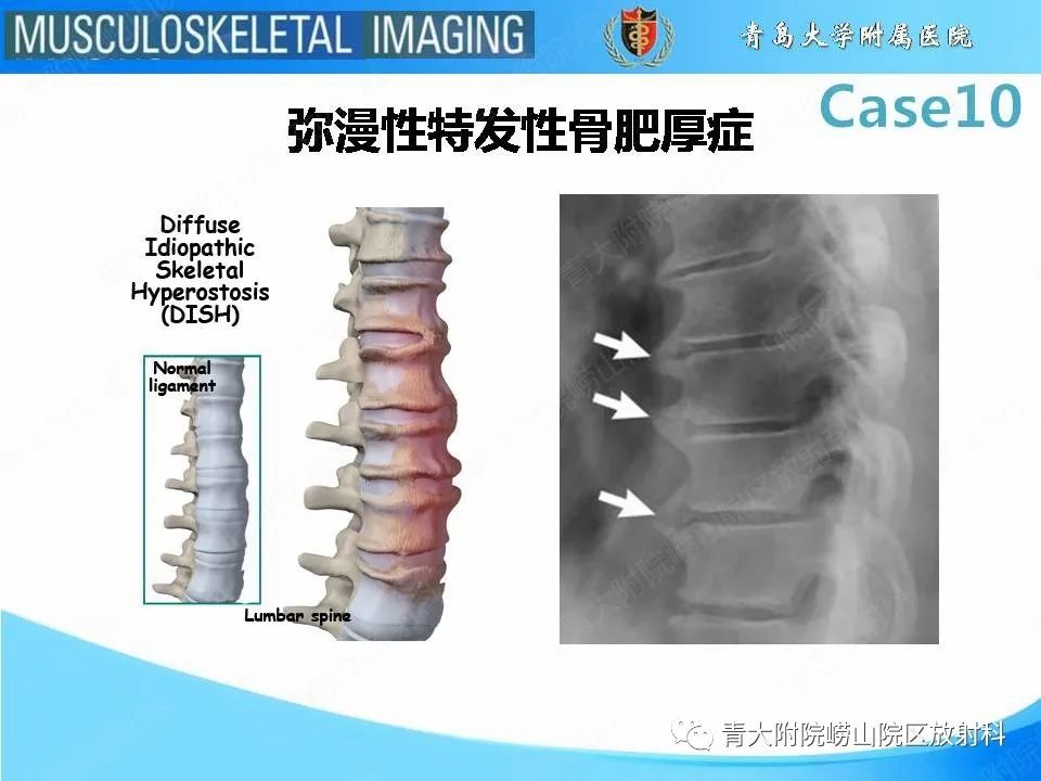 【PPT】后纵韧带骨化症