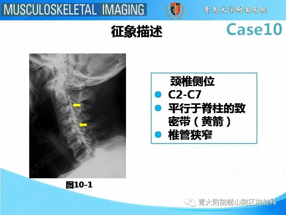 【PPT】后纵韧带骨化症