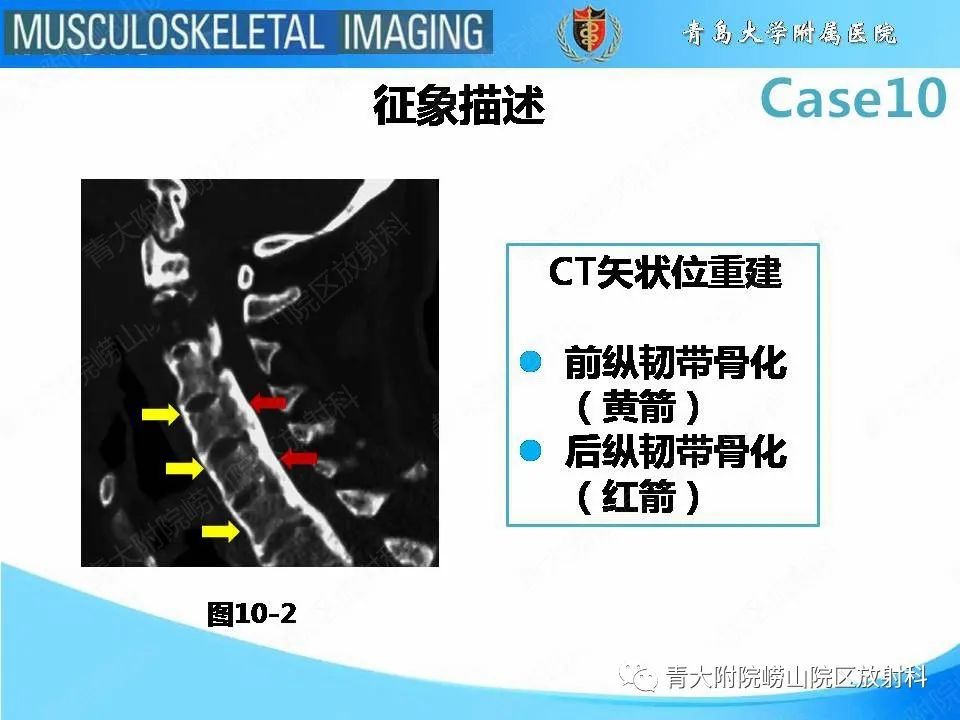 【PPT】后纵韧带骨化症