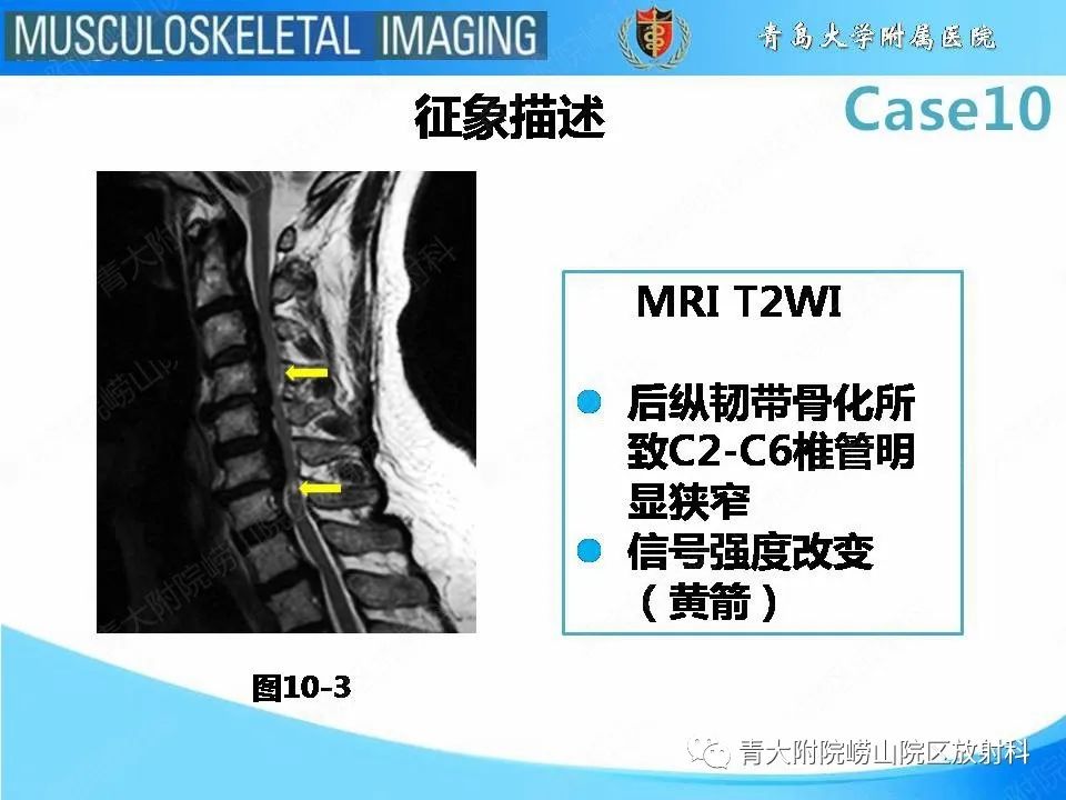 【PPT】后纵韧带骨化症