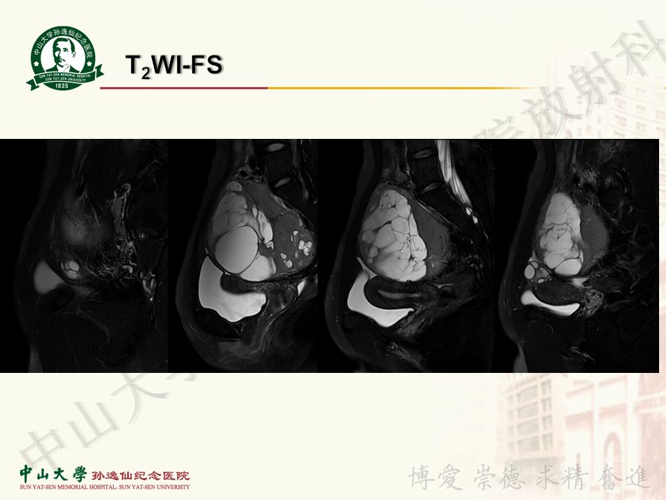 【病例】盆腔Castleman病 （巨大淋巴结增生症）1例MR