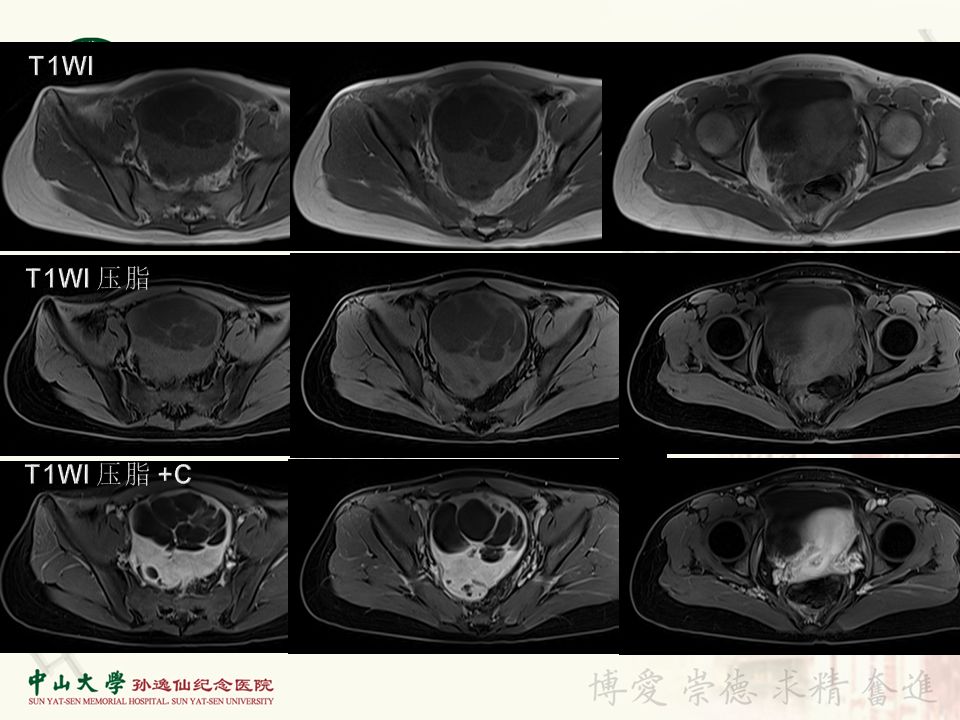【病例】盆腔Castleman病 （巨大淋巴结增生症）1例MR