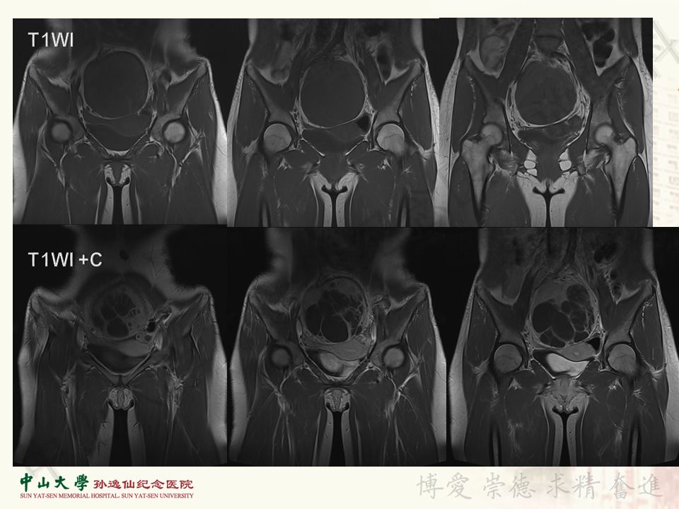 【病例】盆腔Castleman病 （巨大淋巴结增生症）1例MR