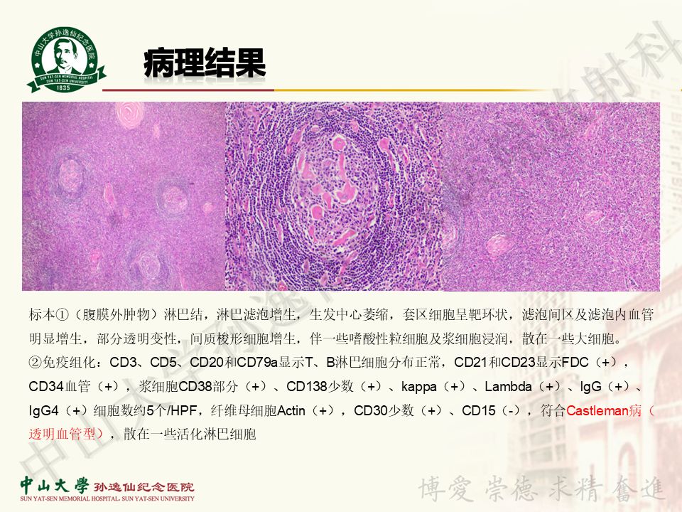 【病例】盆腔Castleman病 （巨大淋巴结增生症）1例MR