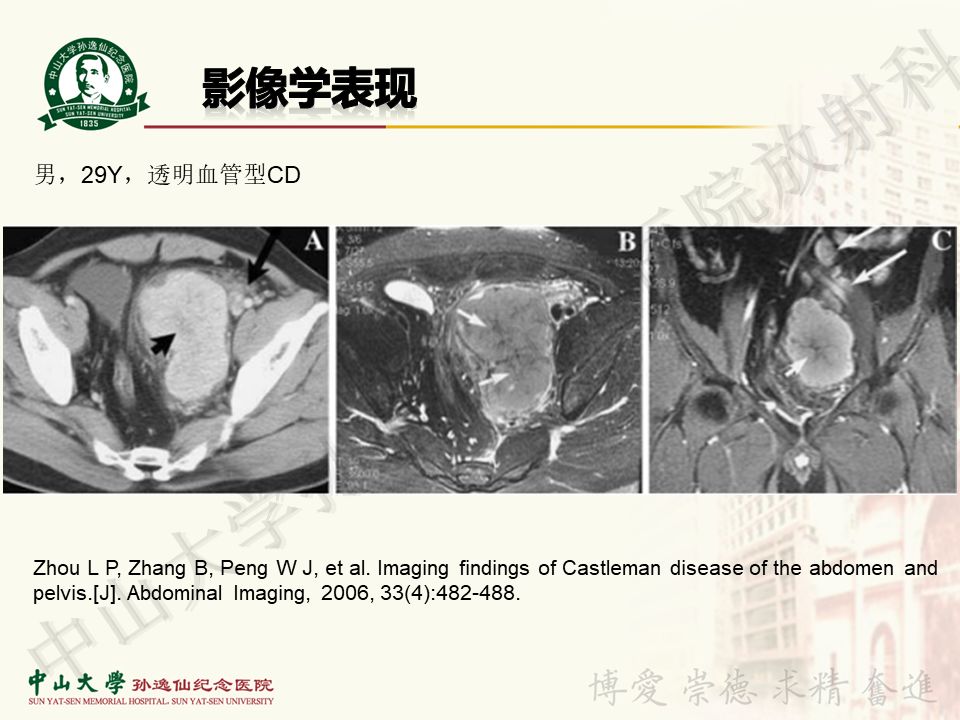 【病例】盆腔Castleman病 （巨大淋巴结增生症）1例MR
