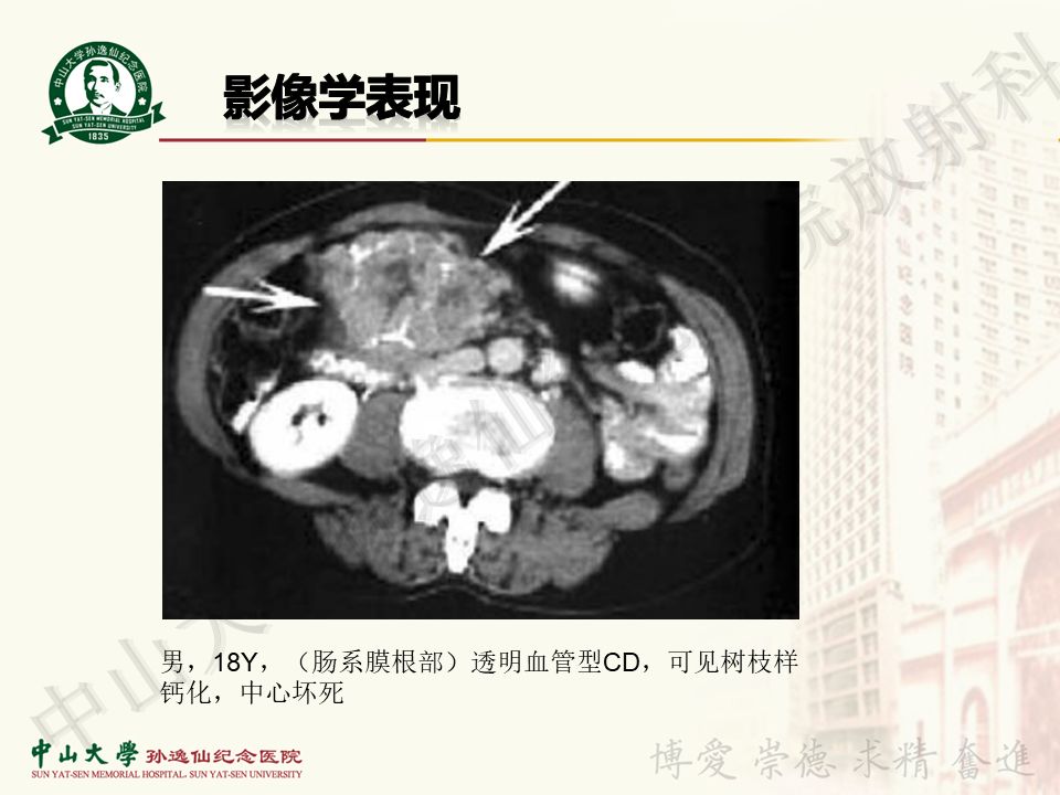 【病例】盆腔Castleman病 （巨大淋巴结增生症）1例MR