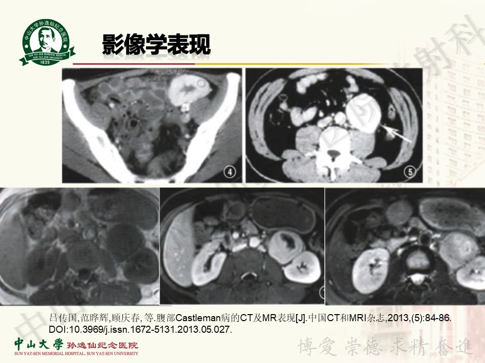 【病例】盆腔Castleman病 （巨大淋巴结增生症）1例MR