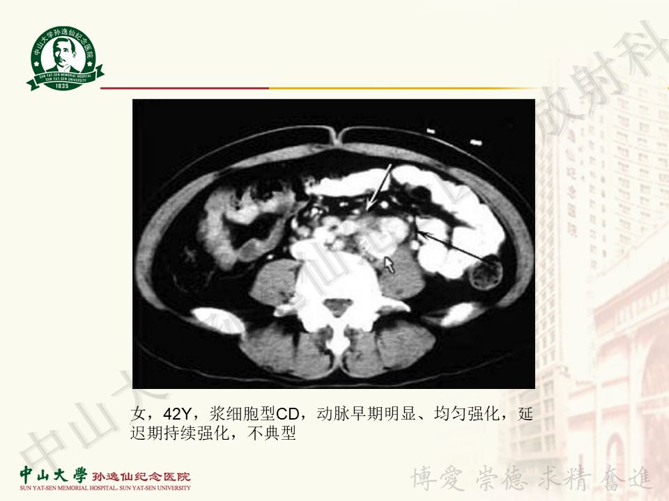 【病例】盆腔Castleman病 （巨大淋巴结增生症）1例MR