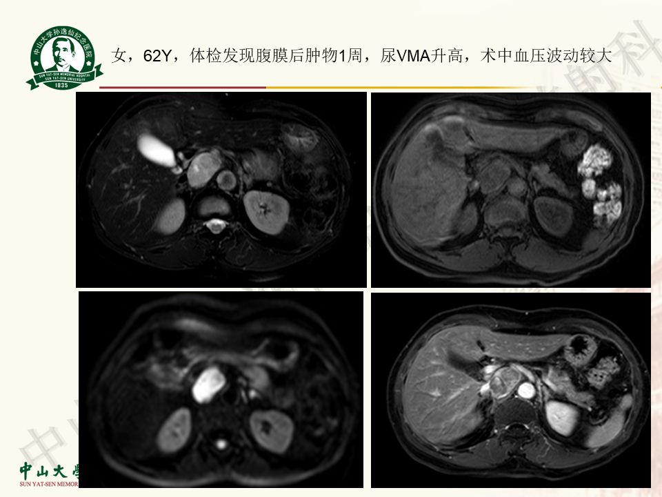 【病例】盆腔Castleman病 （巨大淋巴结增生症）1例MR