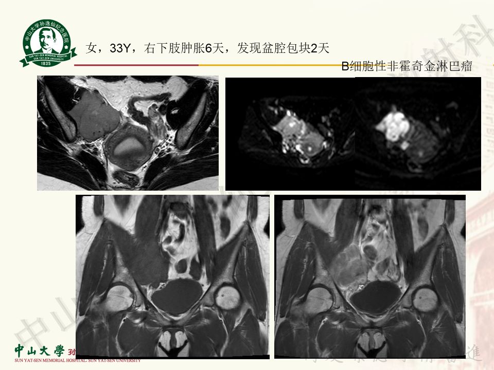 【病例】盆腔Castleman病 （巨大淋巴结增生症）1例MR