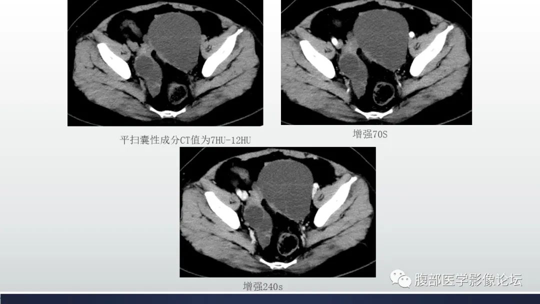 【病例】卵巢囊性腺纤维瘤1例CT影像