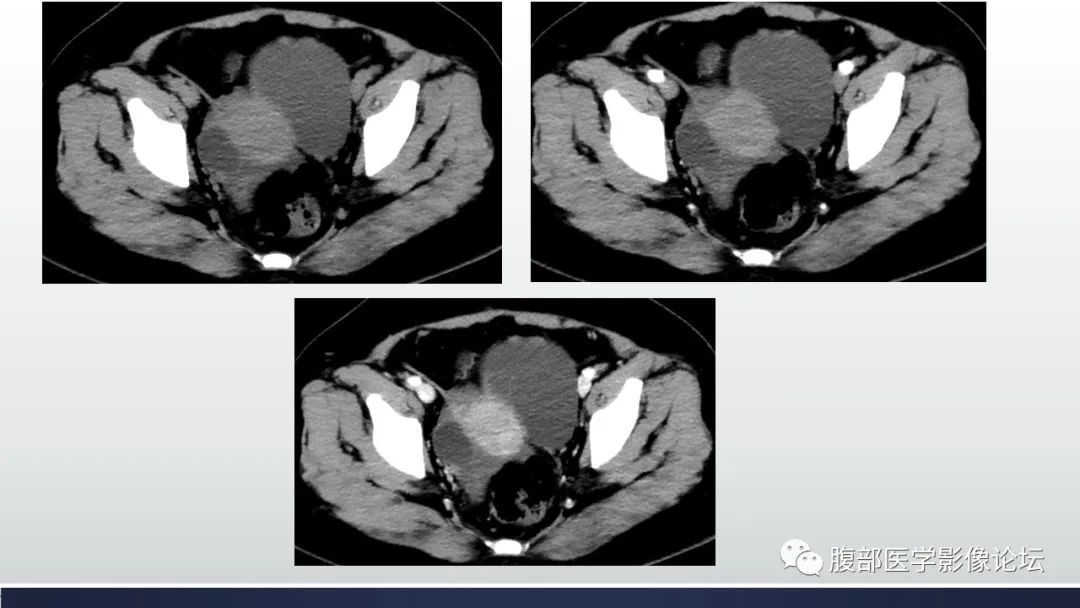 【病例】卵巢囊性腺纤维瘤1例CT影像