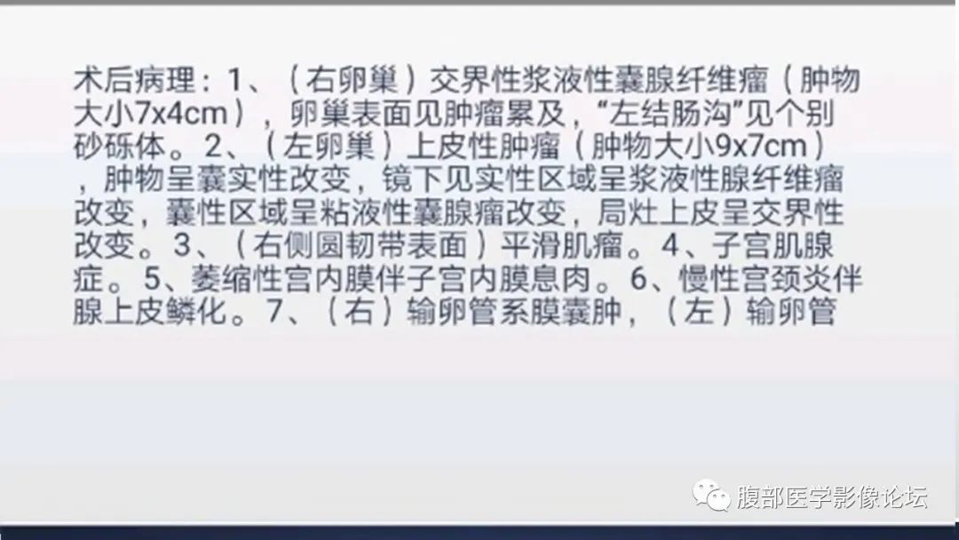【病例】卵巢囊性腺纤维瘤1例CT影像