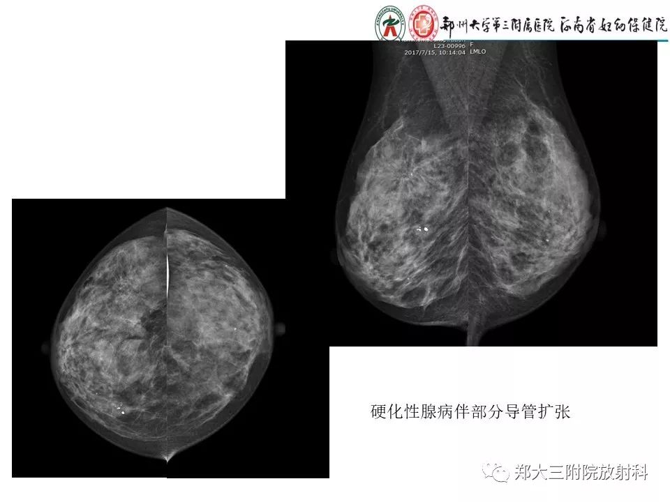 【PPT】乳腺X线特殊征象与合并征象
