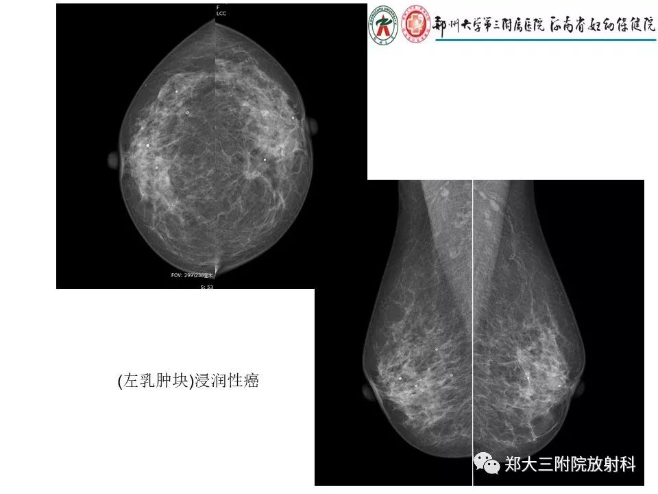 【PPT】乳腺X线特殊征象与合并征象