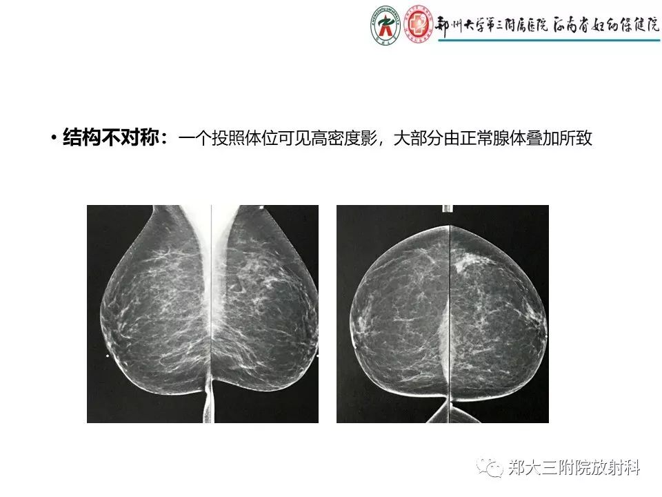【PPT】乳腺X线特殊征象与合并征象