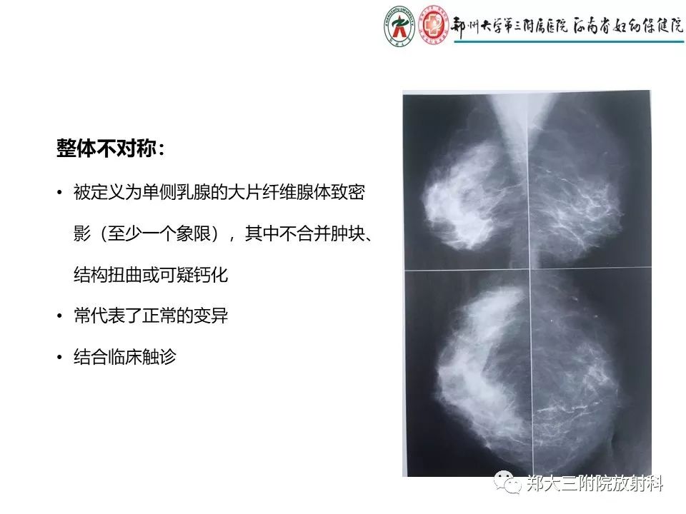 【PPT】乳腺X线特殊征象与合并征象