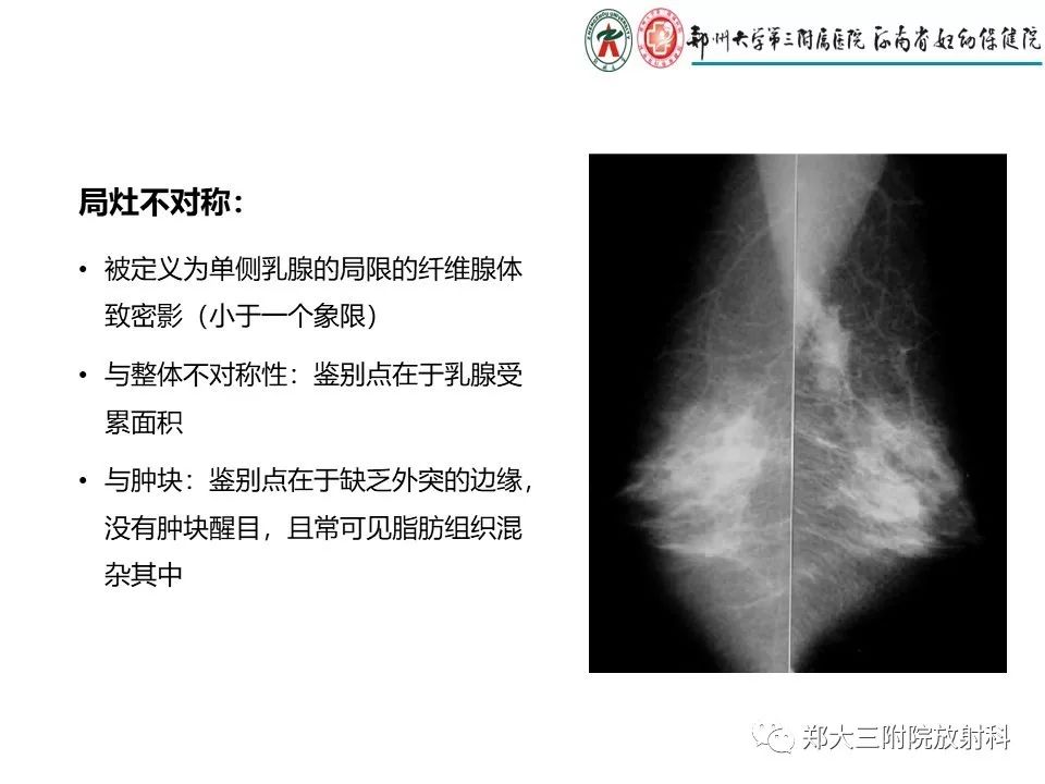 【PPT】乳腺X线特殊征象与合并征象