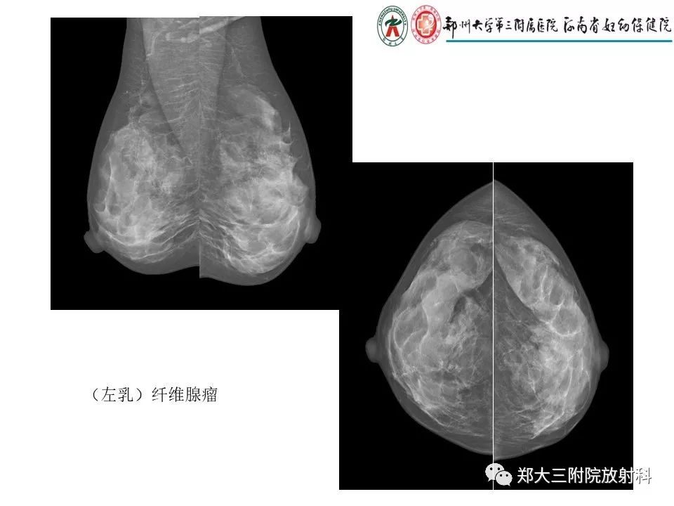 【PPT】乳腺X线特殊征象与合并征象