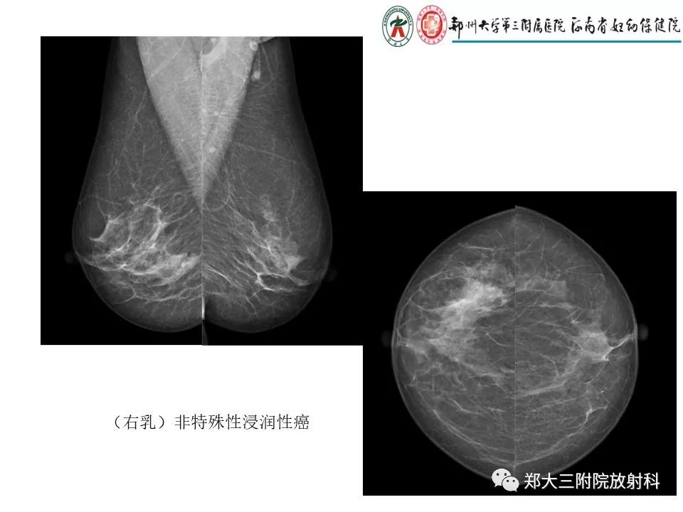 【PPT】乳腺X线特殊征象与合并征象