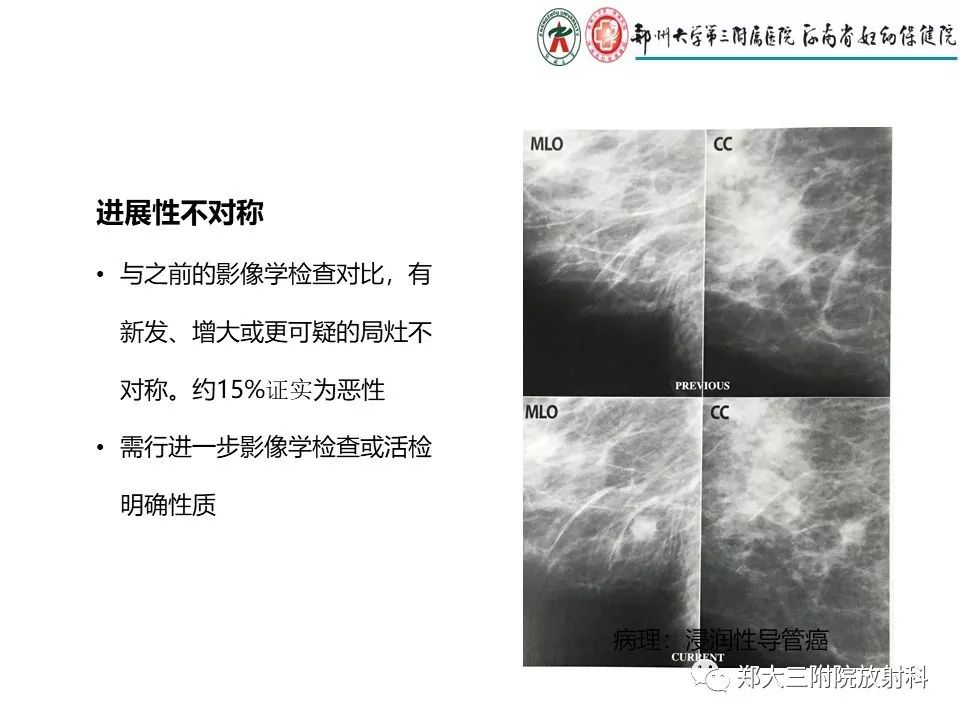 【PPT】乳腺X线特殊征象与合并征象