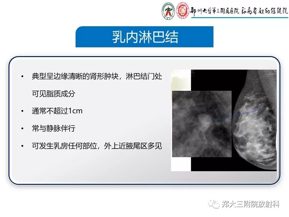【PPT】乳腺X线特殊征象与合并征象