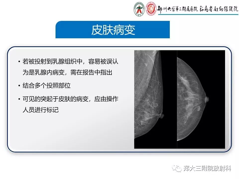 【PPT】乳腺X线特殊征象与合并征象