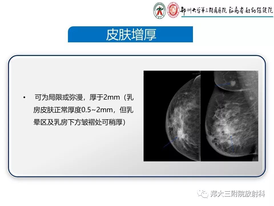 【PPT】乳腺X线特殊征象与合并征象