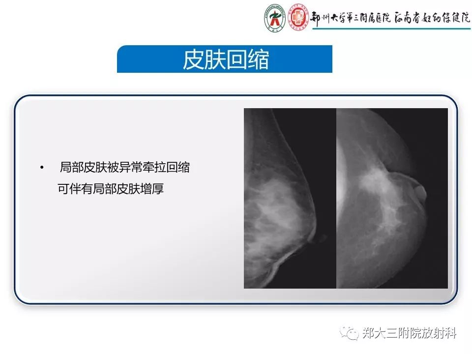 【PPT】乳腺X线特殊征象与合并征象
