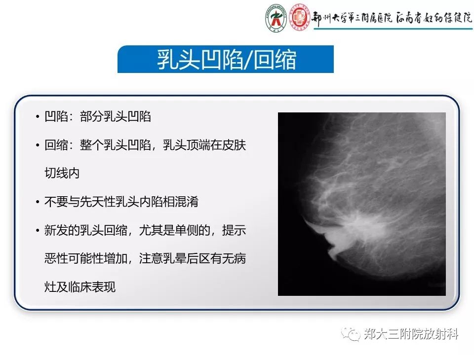 【PPT】乳腺X线特殊征象与合并征象