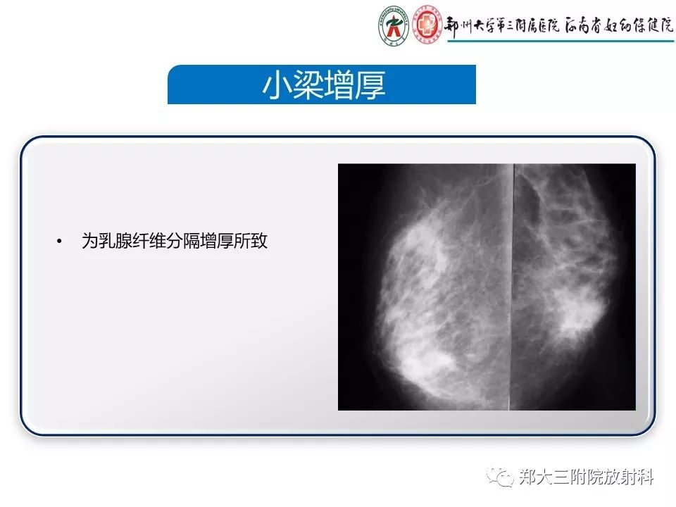 【PPT】乳腺X线特殊征象与合并征象