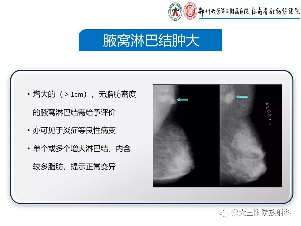 【PPT】乳腺X线特殊征象与合并征象