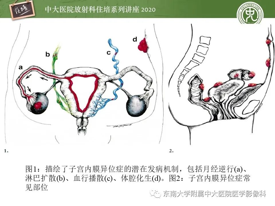 【PPT】子宫内膜异位症与子宫腺肌症的MR诊断