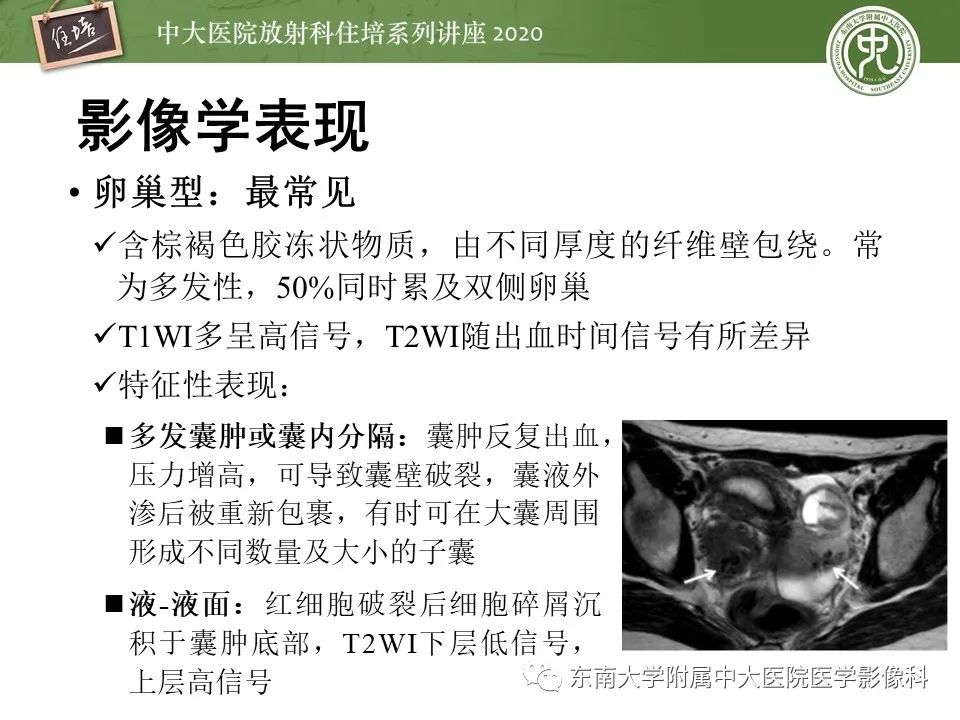 【PPT】子宫内膜异位症与子宫腺肌症的MR诊断