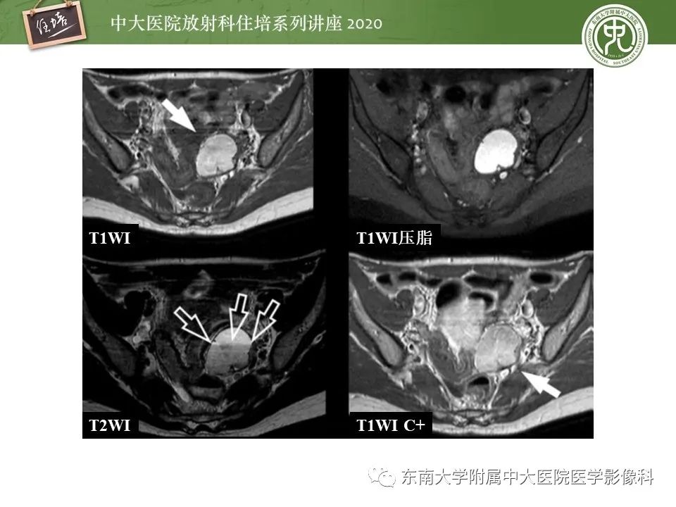 【PPT】子宫内膜异位症与子宫腺肌症的MR诊断