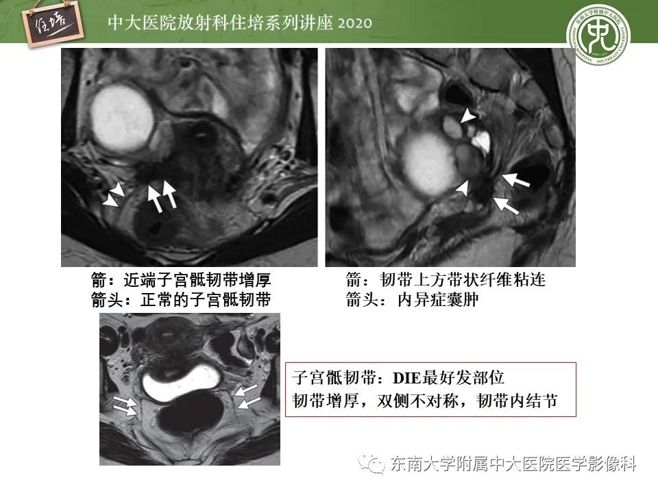 【PPT】子宫内膜异位症与子宫腺肌症的MR诊断