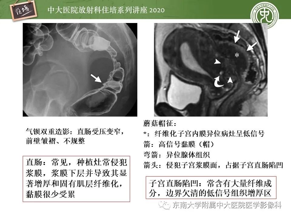 【PPT】子宫内膜异位症与子宫腺肌症的MR诊断