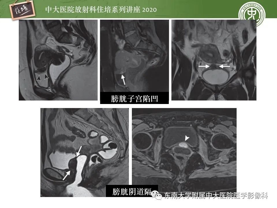 【PPT】子宫内膜异位症与子宫腺肌症的MR诊断