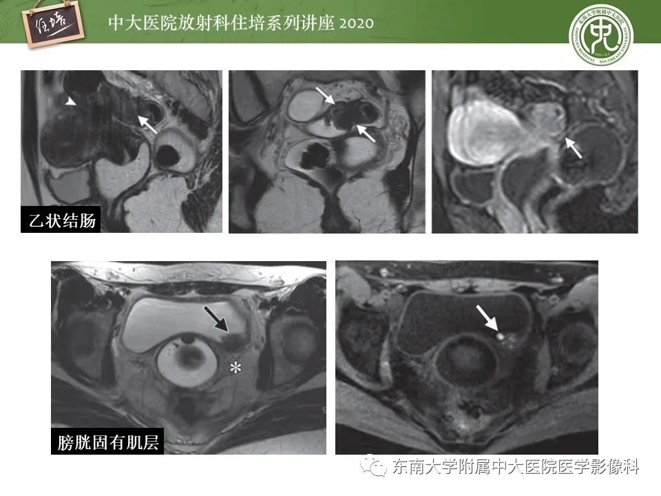 【PPT】子宫内膜异位症与子宫腺肌症的MR诊断