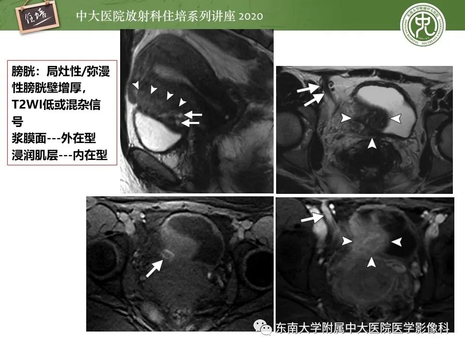 【PPT】子宫内膜异位症与子宫腺肌症的MR诊断