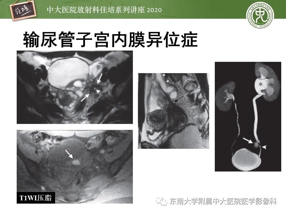 【PPT】子宫内膜异位症与子宫腺肌症的MR诊断