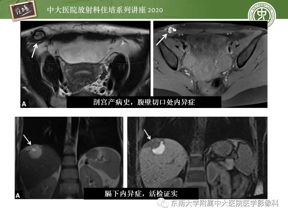 【PPT】子宫内膜异位症与子宫腺肌症的MR诊断