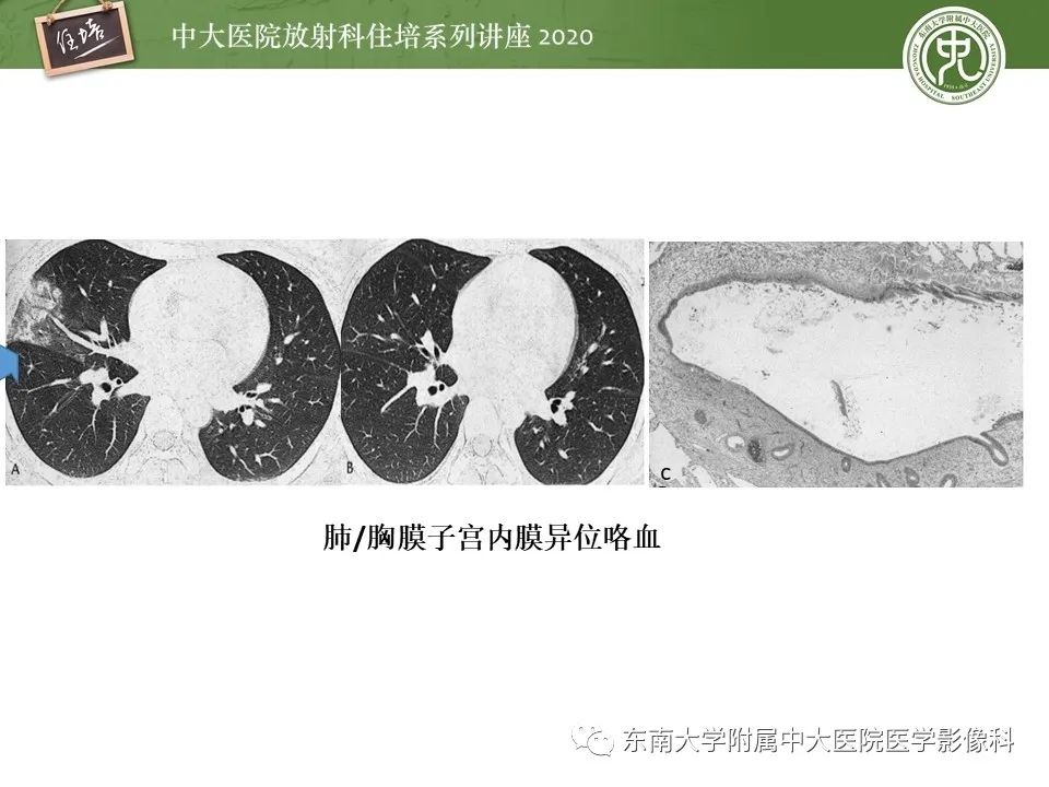 【PPT】子宫内膜异位症与子宫腺肌症的MR诊断