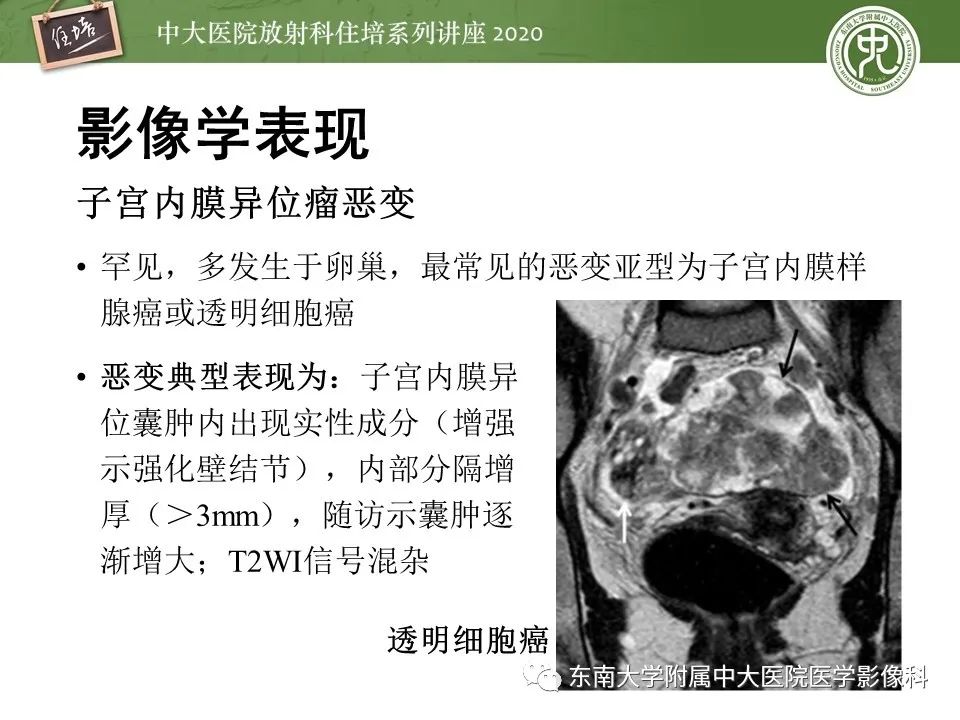 【PPT】子宫内膜异位症与子宫腺肌症的MR诊断