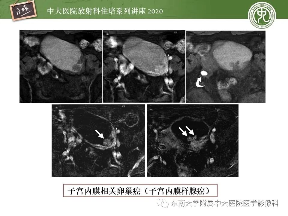 【PPT】子宫内膜异位症与子宫腺肌症的MR诊断