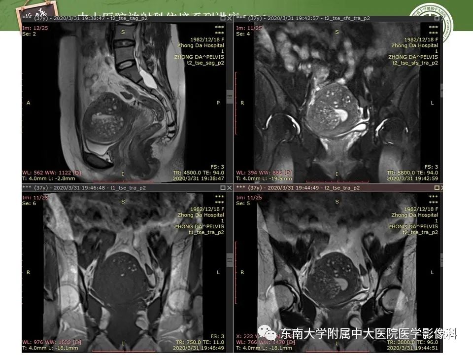 【PPT】子宫内膜异位症与子宫腺肌症的MR诊断