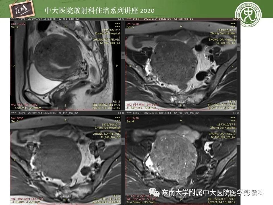 【PPT】子宫内膜异位症与子宫腺肌症的MR诊断