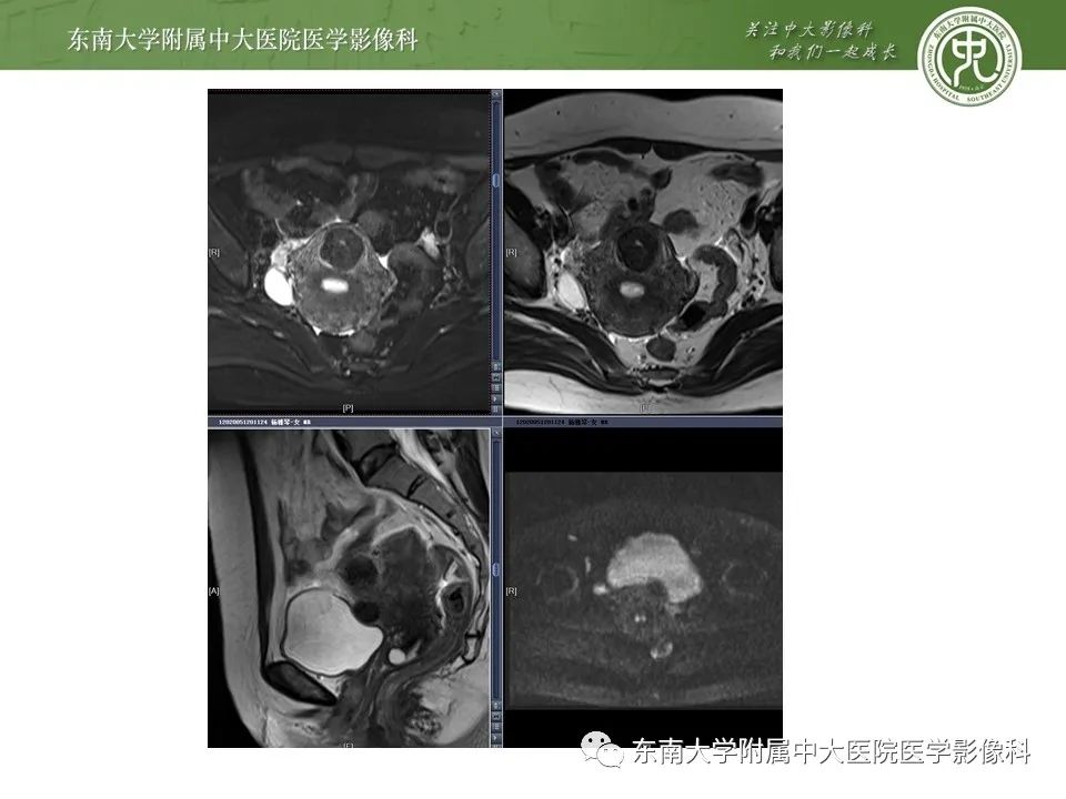 【PPT】子宫内膜异位症与子宫腺肌症的MR诊断